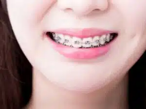 Braces 