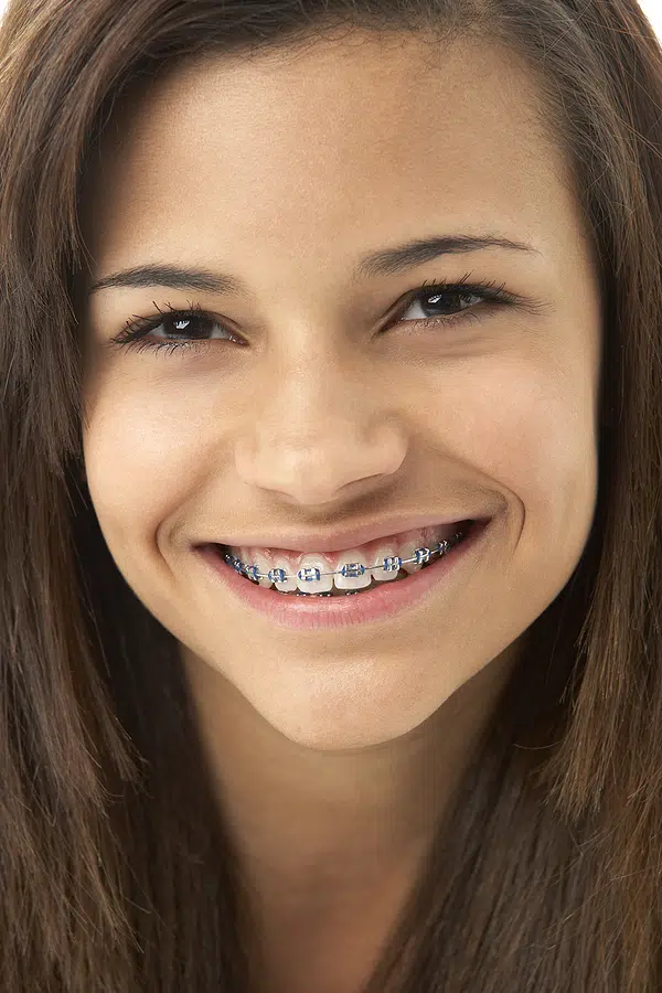 Braces Widen Your Smile