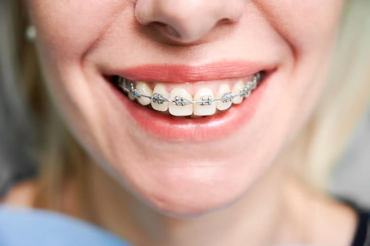 adult braces in Smithtown