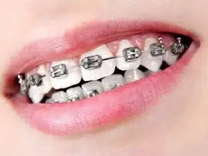 Adult Braces Options