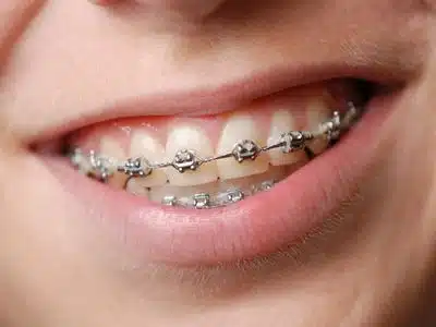 Braces for Adults
